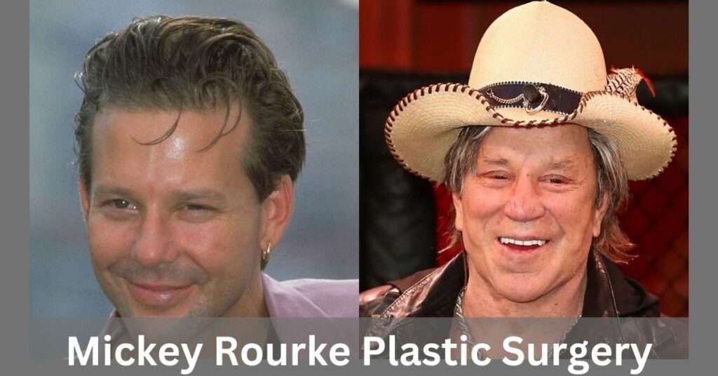 Mickey Rourke Plastic Surgery